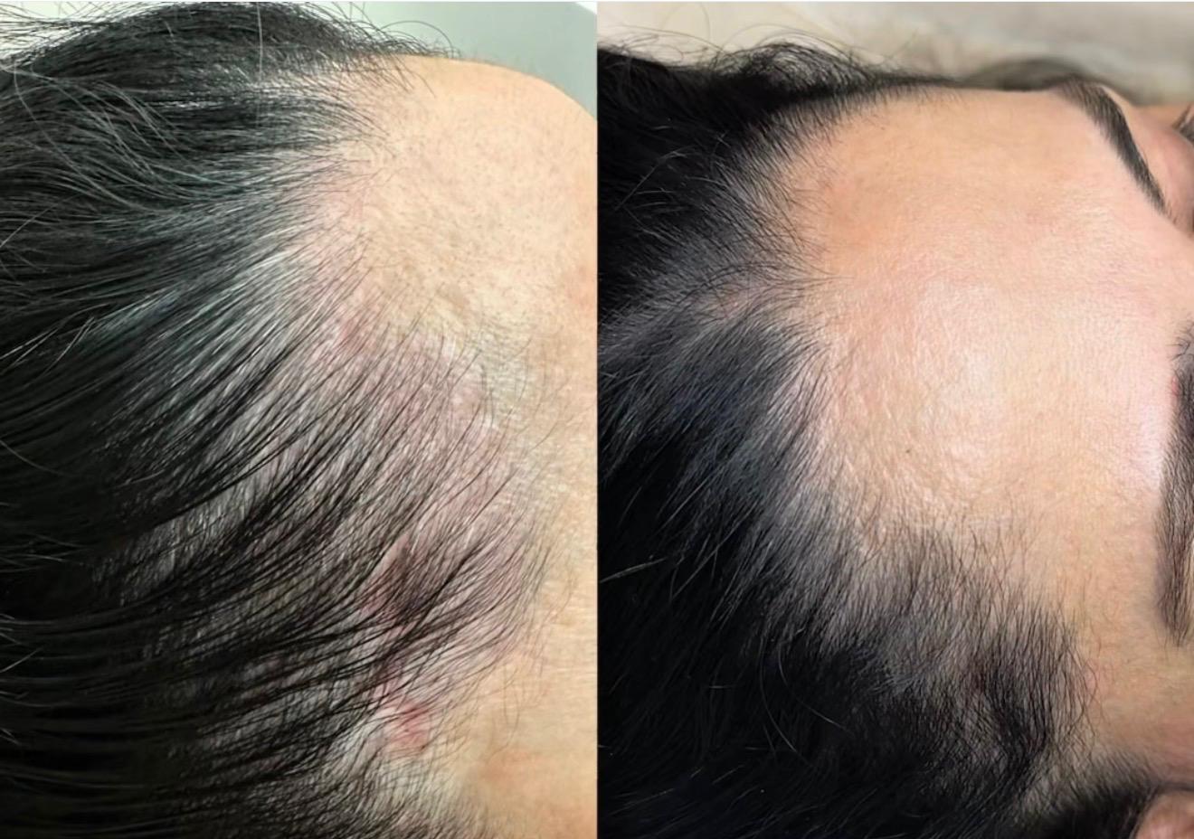 ASCE Hair Before After